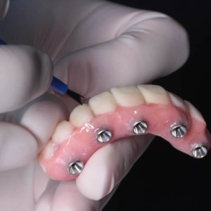 Implant Bridge