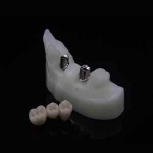 Custom Abutment